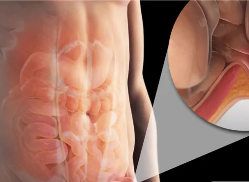 Femoral Hernia consultation at Niraaya Hospital